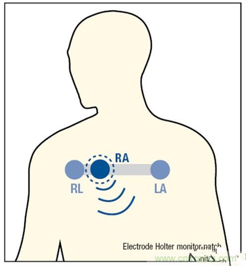 解析：一款可穿戴無線ECG動態(tài)心電監(jiān)護(hù)儀的設(shè)計(jì)